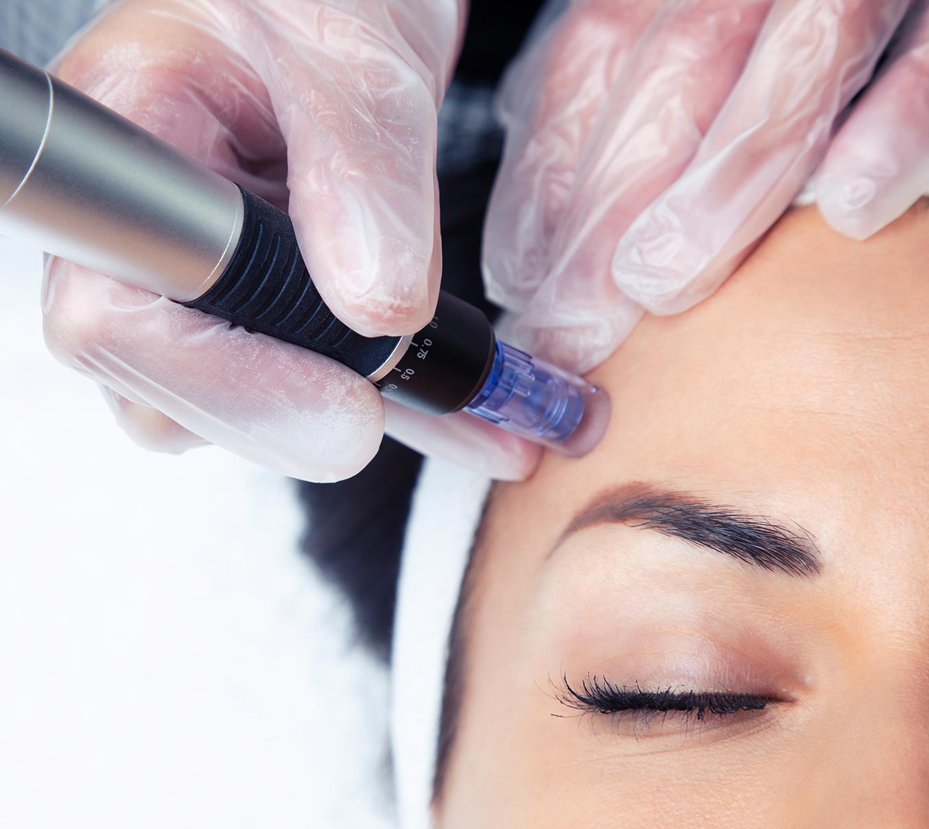 Microneedling Microneedling