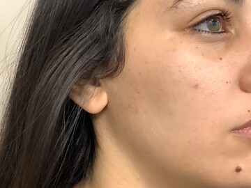 bienfaits du peeling réalisé par Docteur Harroch au centre esthétique Skin Lasers à Toulouse.