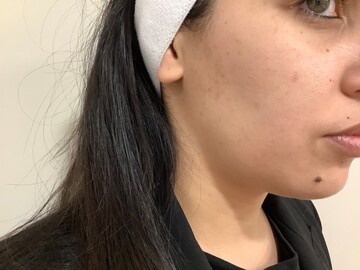 bienfaits du peeling réalisé par Docteur Harroch au centre esthétique Skin Lasers à Toulouse.